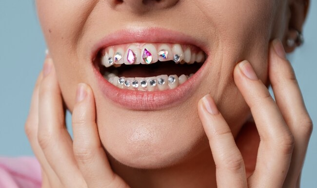 What Are the Different Types of Braces?